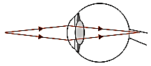 Optical instrument eyeglasses – problems and solutions 3