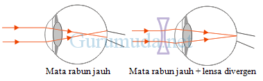 Pembahasan soal cacat mata 5