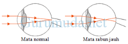 Pembahasan soal cacat mata 7